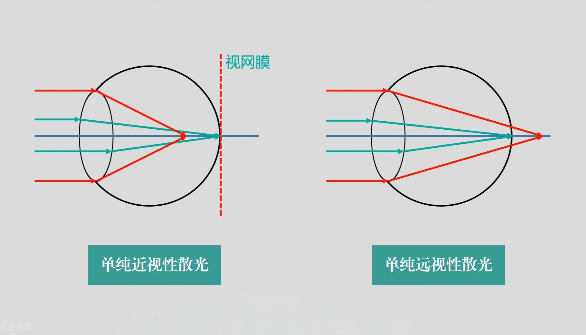 单纯性散光.jpg