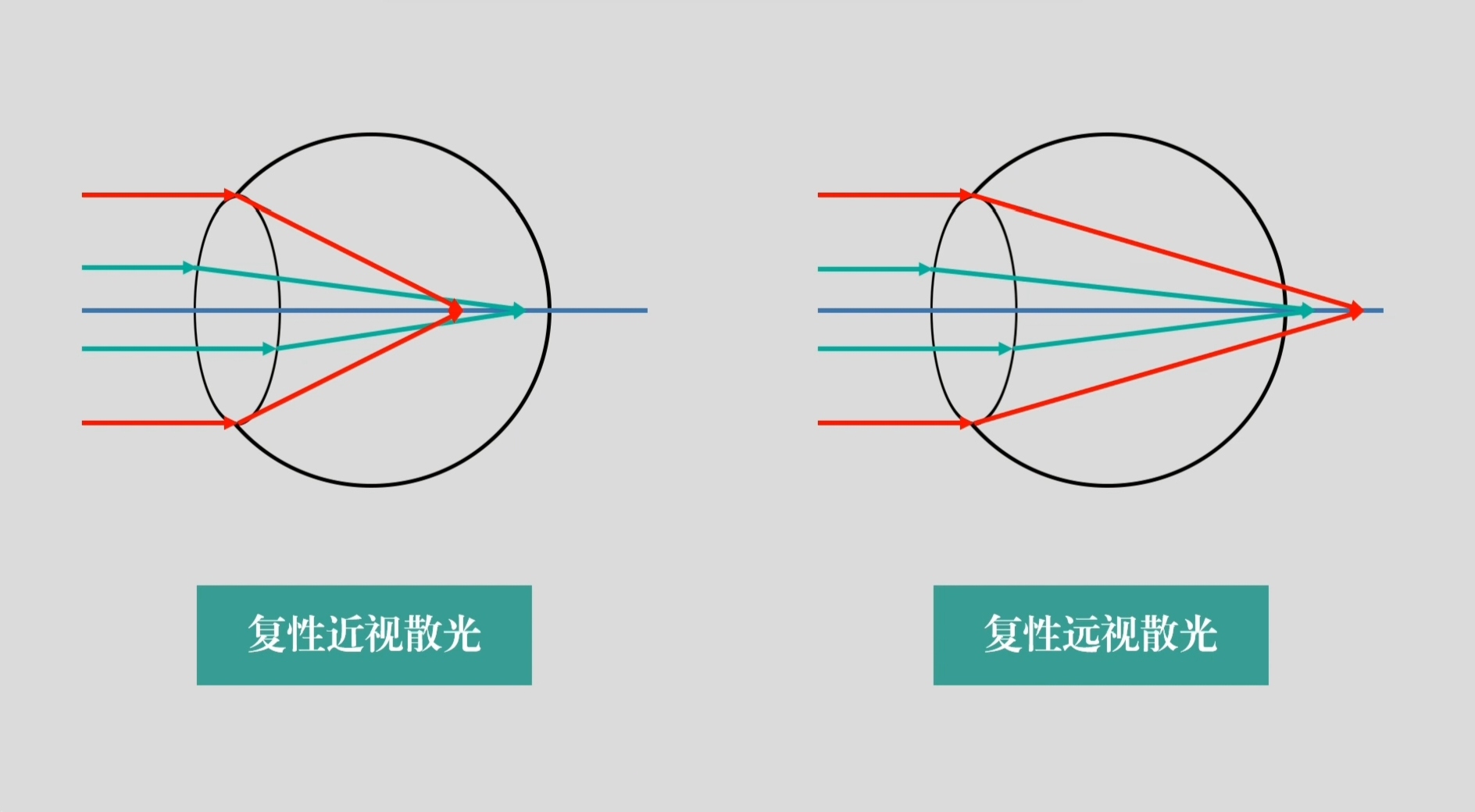 复性散光.jpg